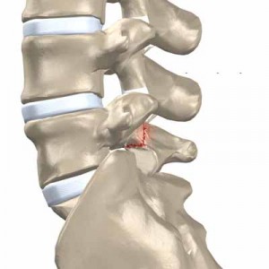 Spondylothesis-1