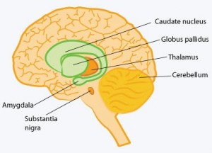 parkinson's disease