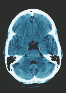 Tourette syndrome