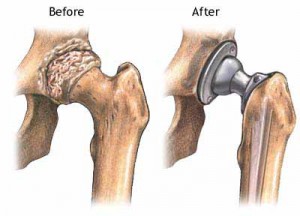 hip replacement