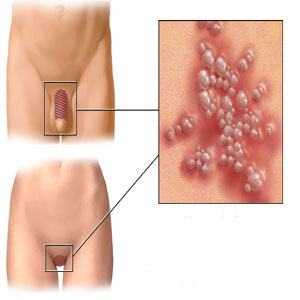 hpv infection