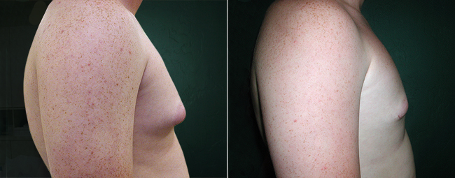 male boobs