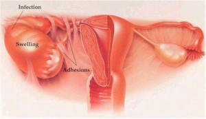 pelvic inflammatory disease