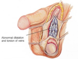 varicocele male infertility