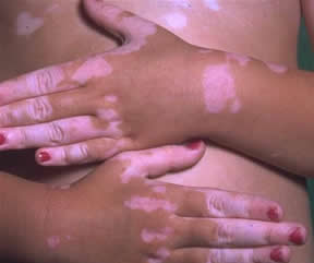 vitiligo