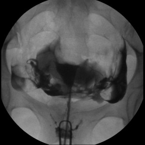 Hysterosalpingogram