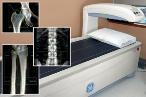 osteoporosis bone density test