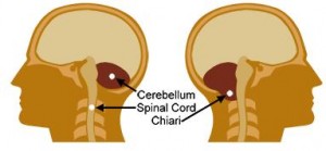 Arnold Chiari Malformation