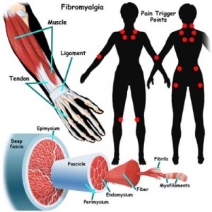 Symptoms of fibromyalgia