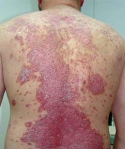 Psoriasis