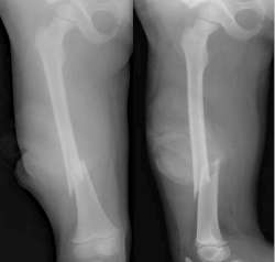 Thigh fractures