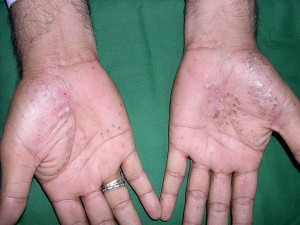 Pustular psoriasis