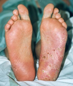 Pustular psoriasis symptoms